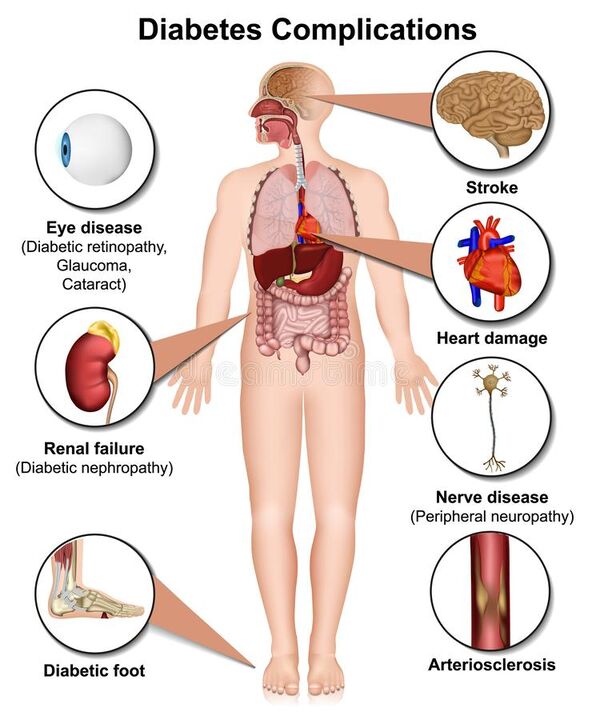 Consecințele diabetului zaharat